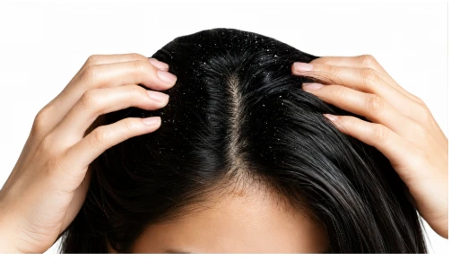 A close-up view of a person's dark hair being parted by hands, revealing white dandruff flakes scattered across the scalp.